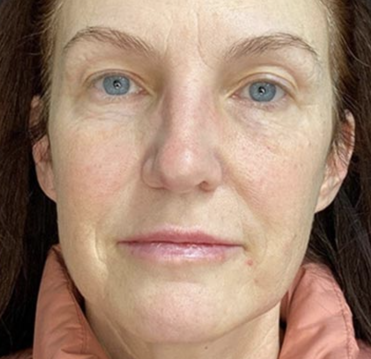 before and after botox