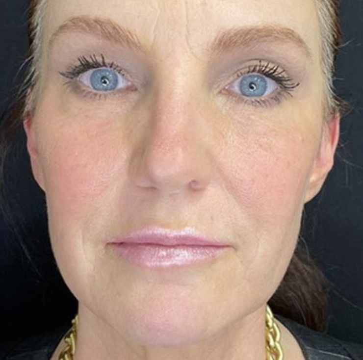 before and after botox