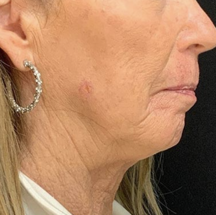 before and after Hyper Dilute Radiesse