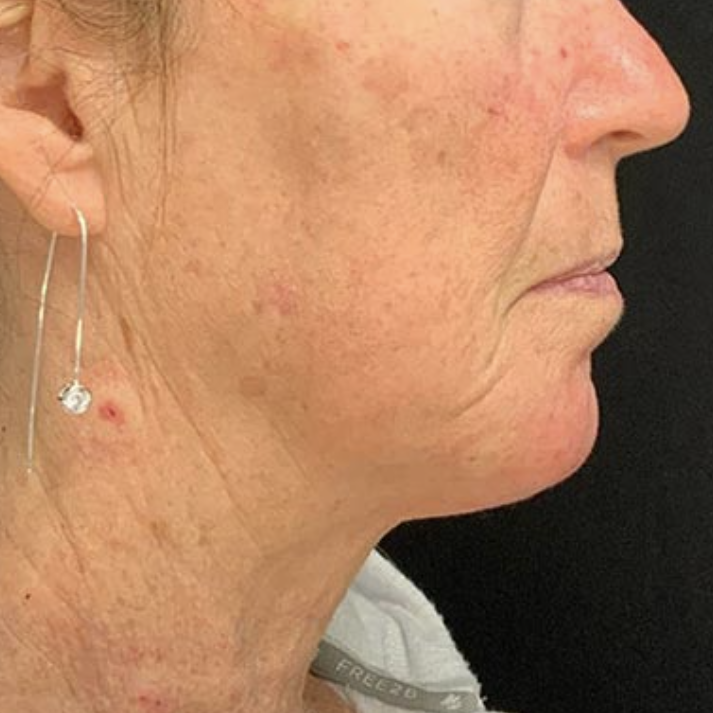 before and after Hyper Dilute Radiesse