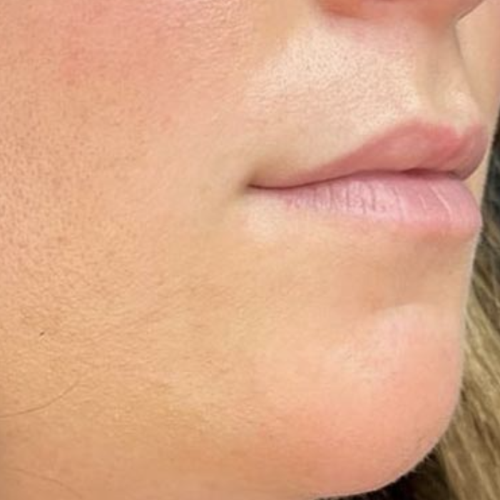 before and after Lip Filler