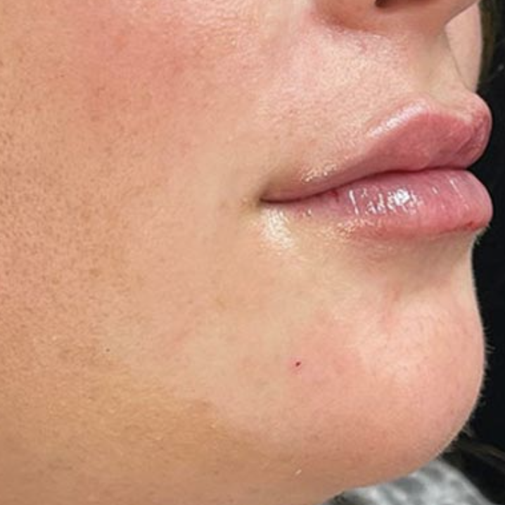 before and after Lip Filler